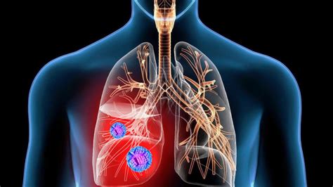 akciğer kanseri yenenler